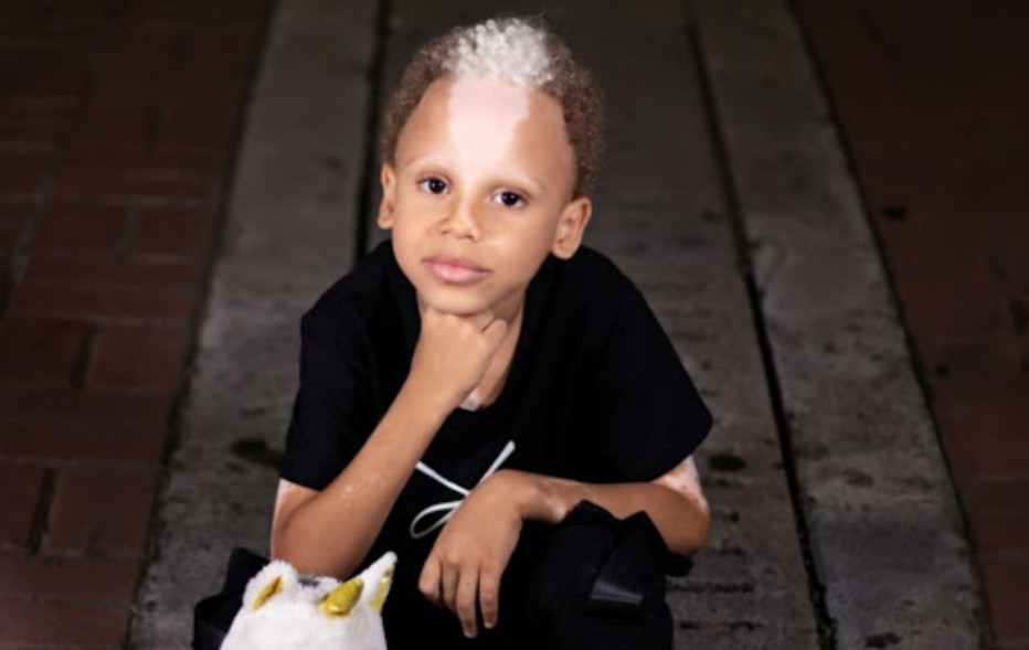Este niño nació con una apariencia única: mira lo que hace y cómo luce ahora